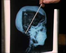 Schädel des Tutanchamun im Röntgenbild